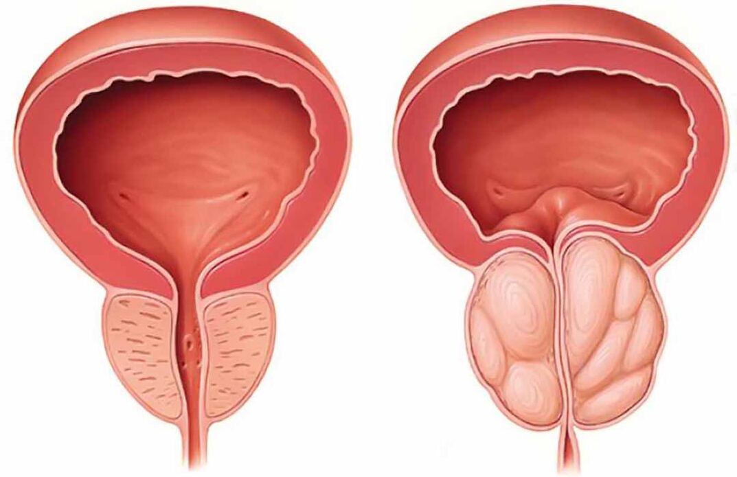 Prostata normale e infiammazione della prostata (prostatite cronica)