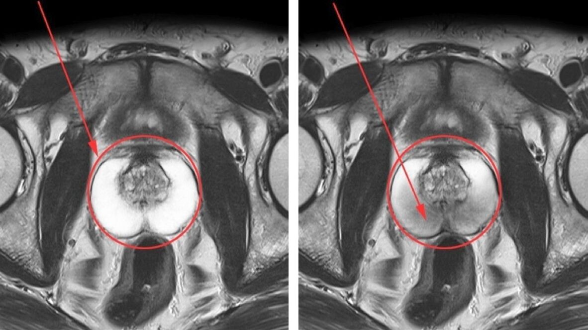 Ecografia per prostatite cronica – prostata sana (a sinistra) e prostata infiammata (a destra)