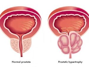Prostata normale e infiammata
