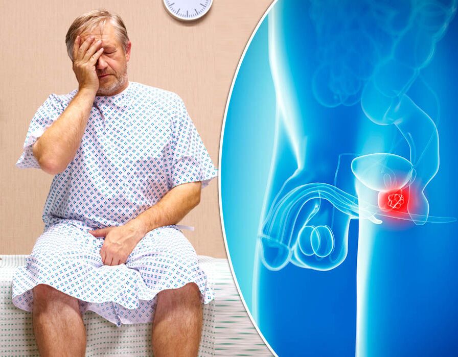 A un uomo affetto da prostatite viene diagnosticata la malattia