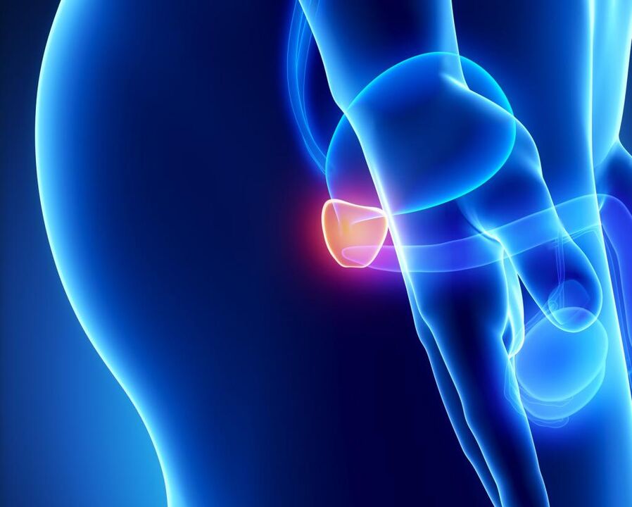 Infiammazione della prostata