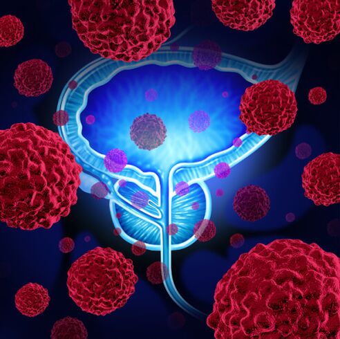 L'attività dei microrganismi patogeni è la causa dello sviluppo della prostatite