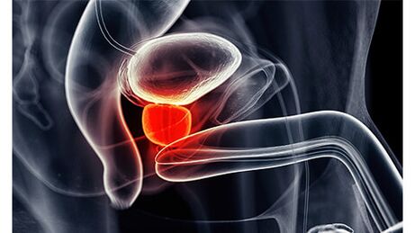 Infiammazione della ghiandola prostatica