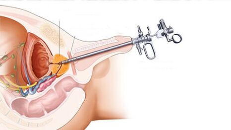 Trattamento chirurgico della prostatite